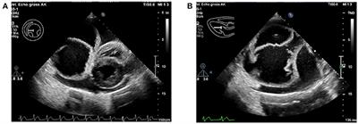 Case Report: Unusual Peritoneopericardial Diaphragmatic Hernia in an 8-Month-Old German Shepherd Dog, Associated With a Pericardial Pseudocyst and Coexisting Severe Pericardial Effusion Resulting in Right-Sided Heart Failure